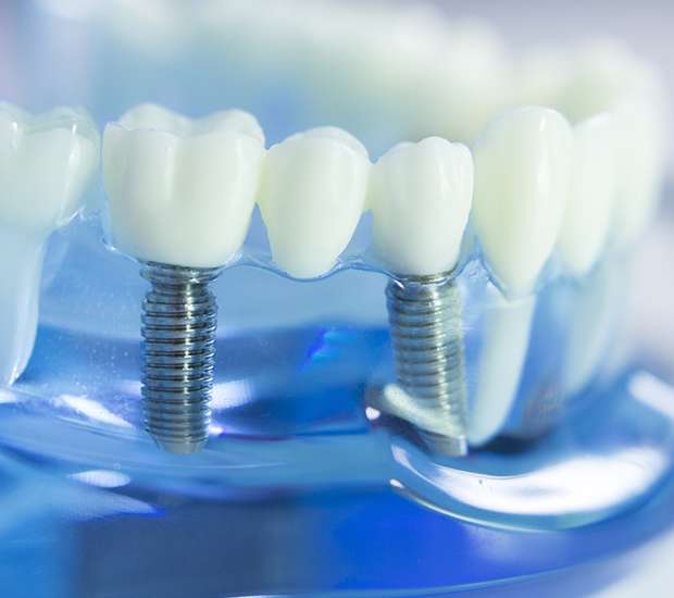 Williamsburg Dental Implants